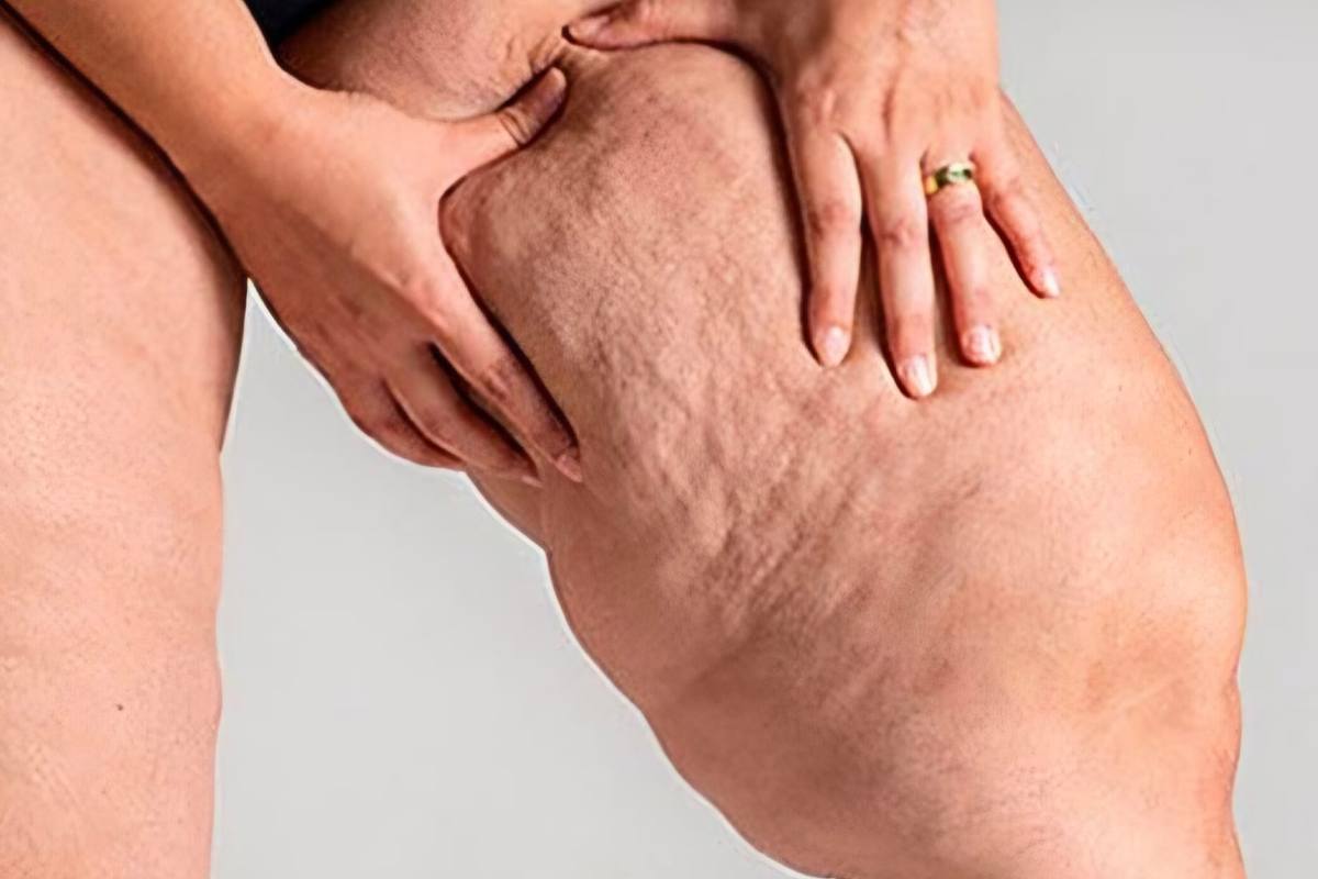 Lipedema come riconoscerlo