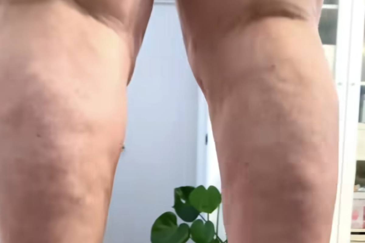 Lipedema come riconoscerlo