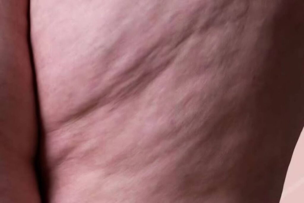 Lipedema come riconoscerlo