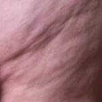 Lipedema come riconoscerlo