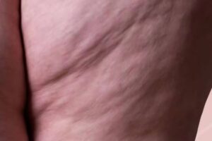 Lipedema come riconoscerlo