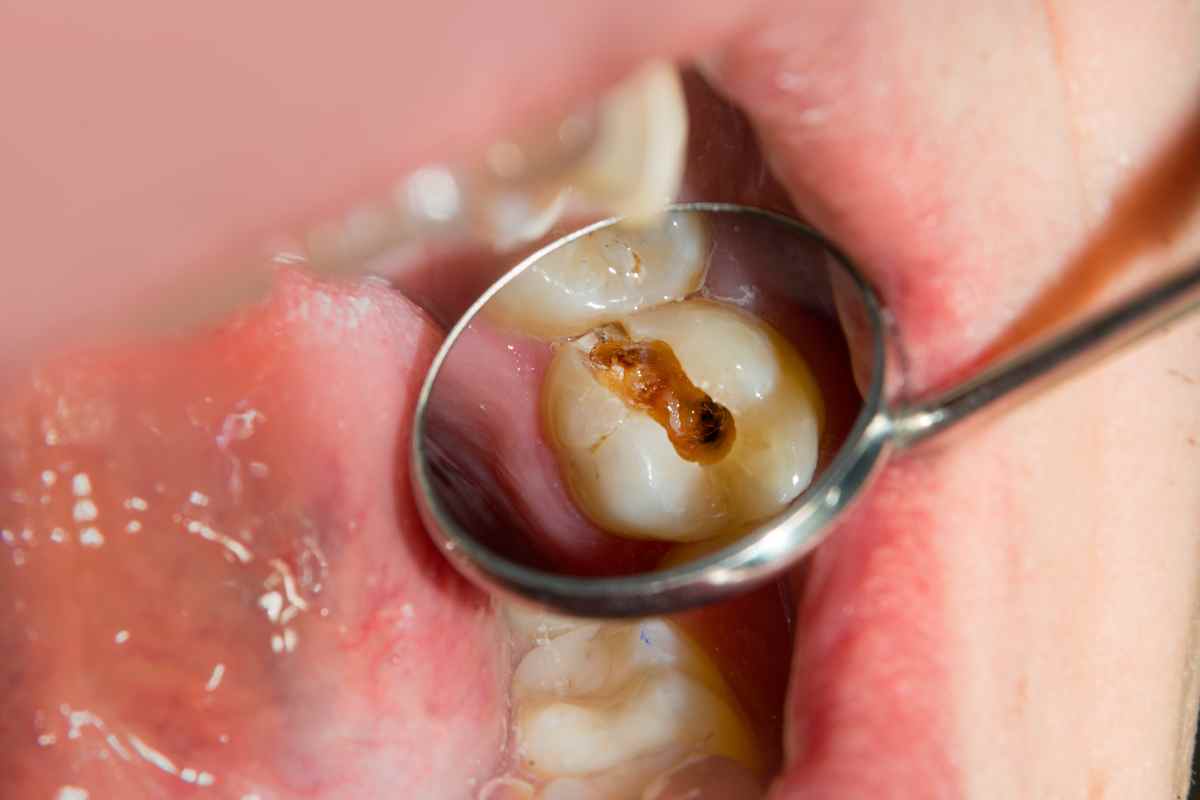 dentista guarda una carie in bocca