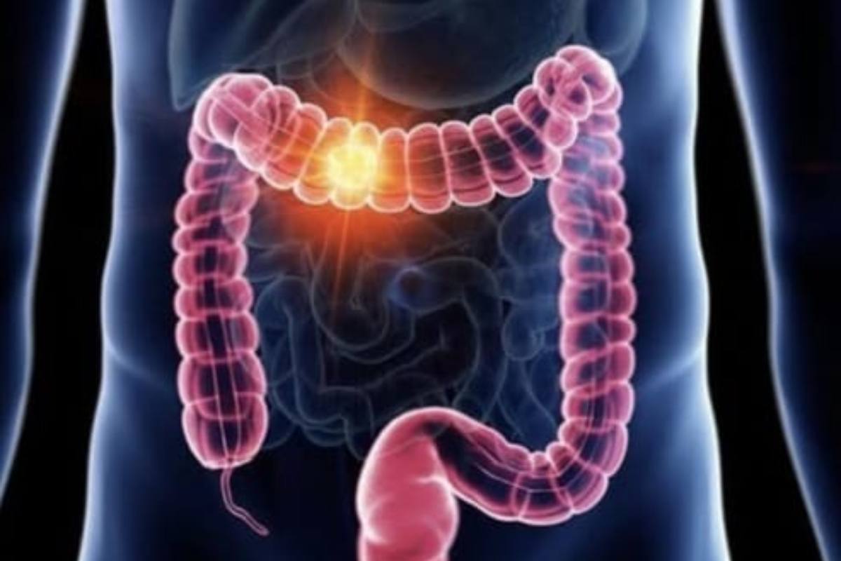 Tumore colon retto nuovo bersaglio
