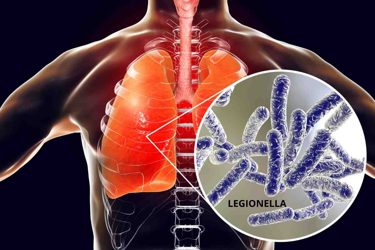 Legionella cosa c'è da sapere